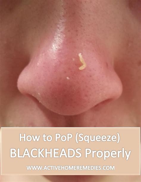 Should I squeeze blackheads?