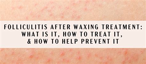 Should I stop waxing if I get folliculitis?