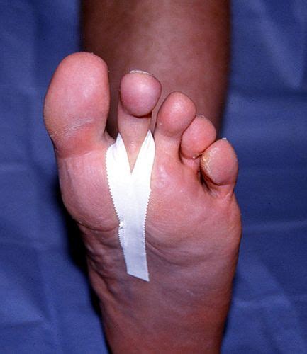 Should I tape my toes when running?