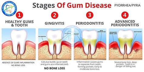 Should I worry about periodontitis?