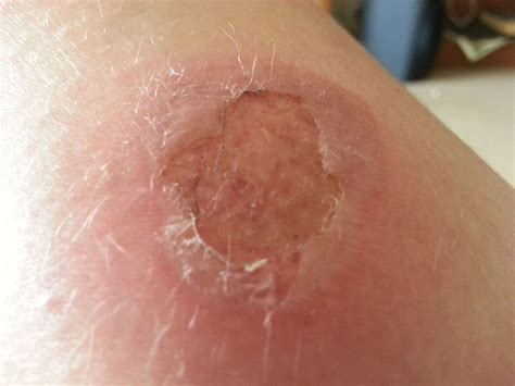 Should a 2nd degree burn be covered?