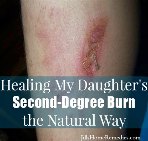 Should a burn still hurt a week later?