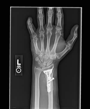 Should plate and screws be removed from wrist?