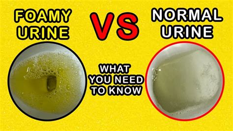 Should urine have bubbles?