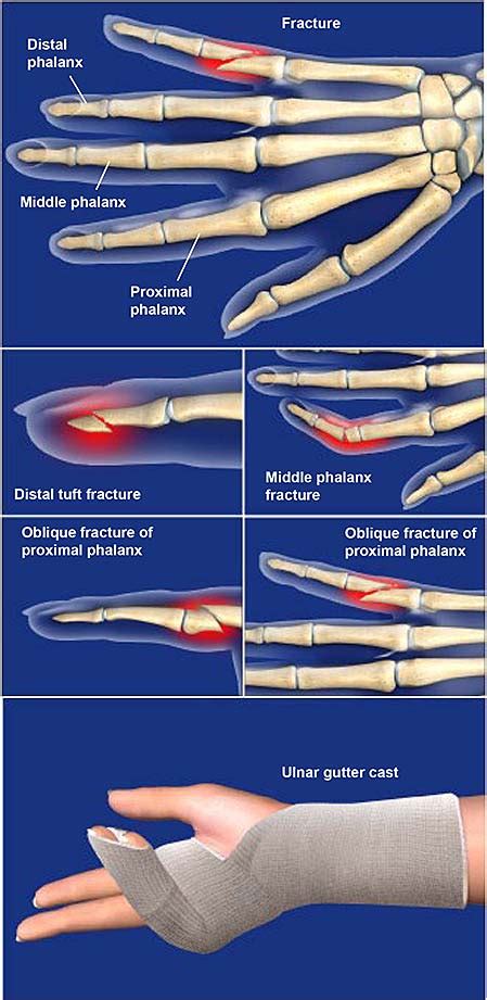Should you bend a fractured finger?