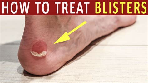 Should you cover a blister overnight?