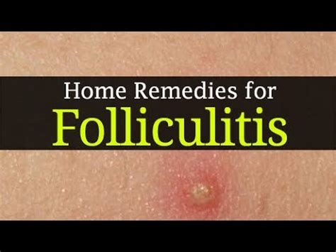 Should you drain folliculitis?
