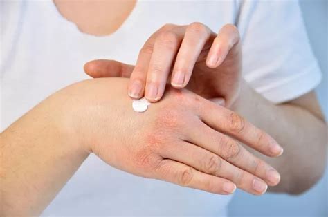Should you dry out or moisturize a rash?
