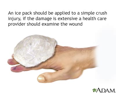 Should you ice a smashed finger?