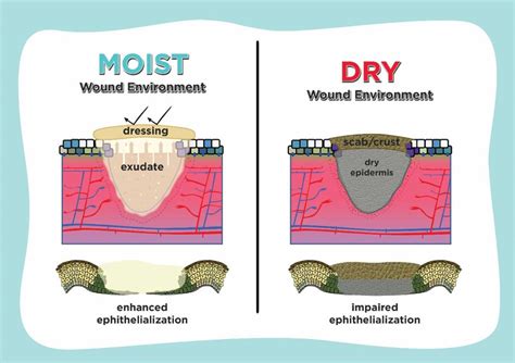Should you keep a burn moist or dry?