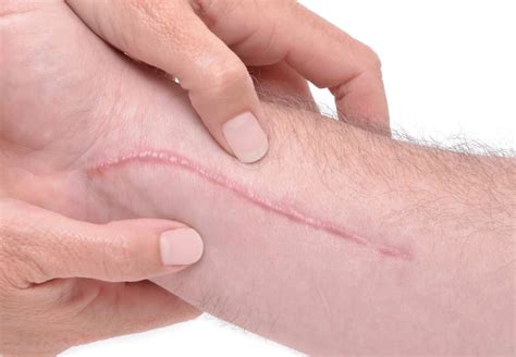 Should you massage scars?