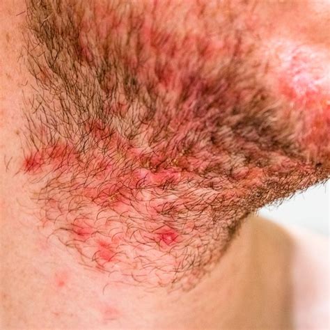 Should you moisturize folliculitis?