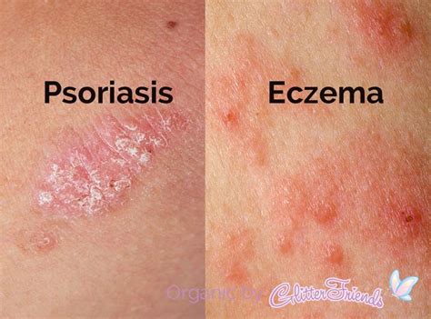 Should you pick flaky skin eczema?