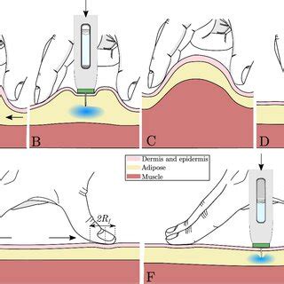 Should you pinch the skin when giving an IM injection?