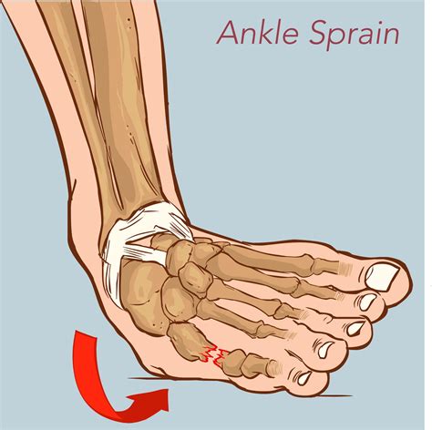 Should you rub a sprained foot?