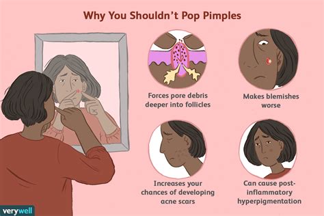 Should you squeeze all the blood out after popping a pimple?
