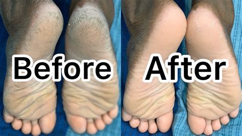 Should you wash the bottom of your feet?