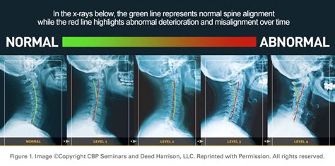 Should your neck have a curve?