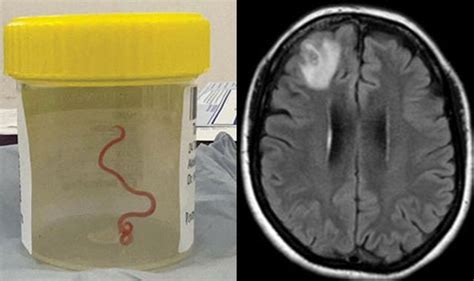 Was a live worm found in the brain?