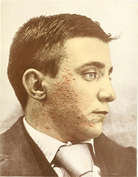 Was acne a thing in the 1800s?