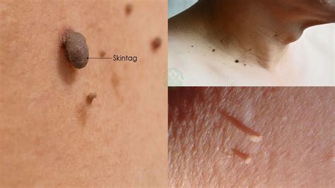 What's inside of a skin tag?