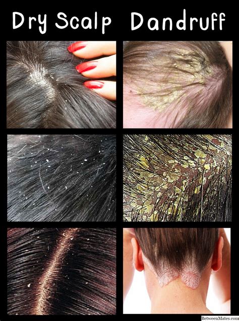 What's the difference between dandruff and dry scalp?