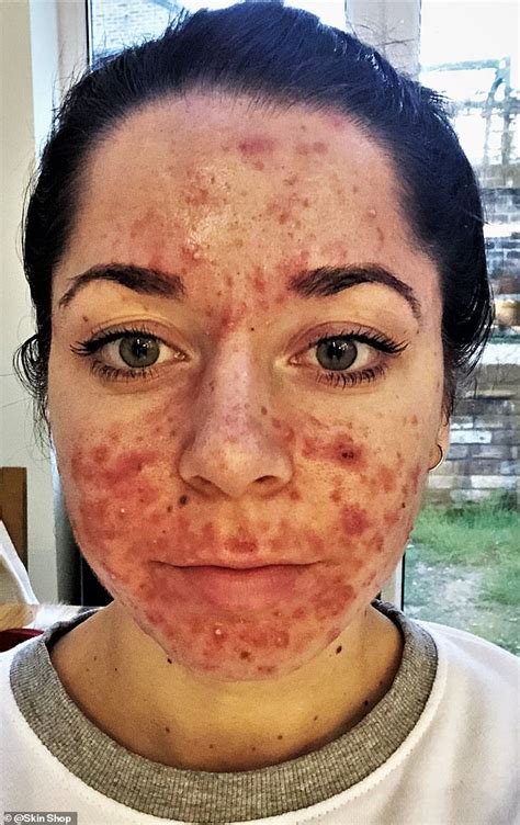 What's the worst place to get acne?