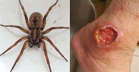 What's the worst spider bite?