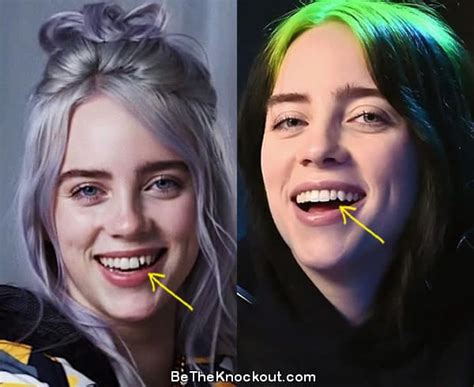 What's up with Billie Eilish teeth?