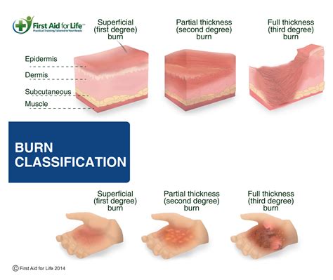 What 5 things should you identify for burns?