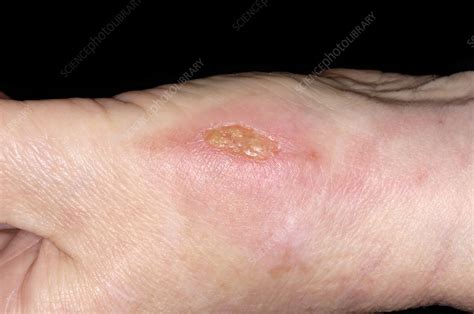 What Colour is an infected burn?