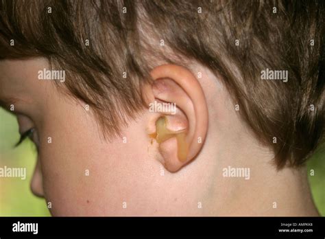 What Colour is ear infection pus?