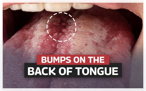 What STD has bumps on the back of the tongue?