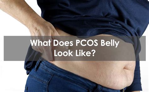 What a PCOS belly looks like?