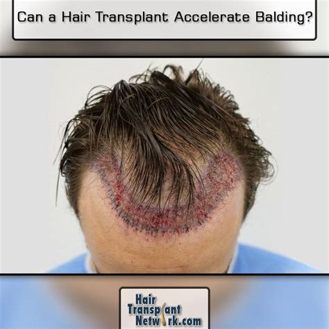 What accelerates balding?