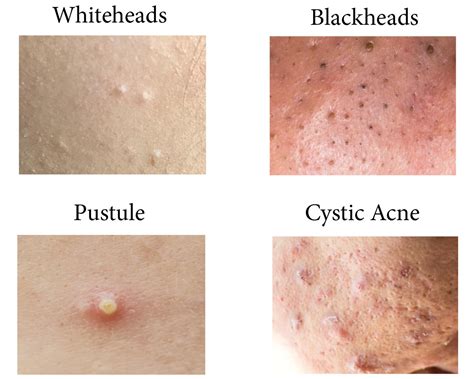 What acne should you not pop?