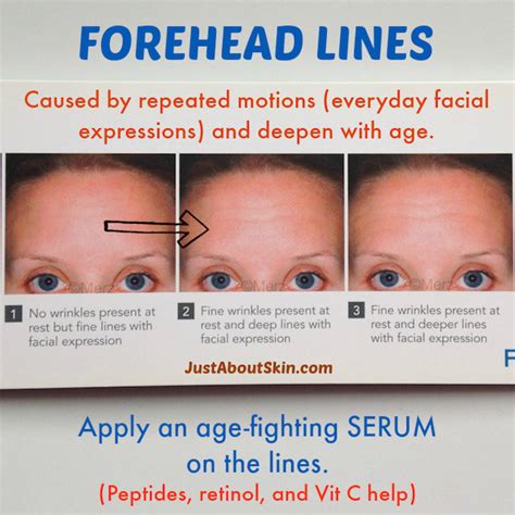 What age do forehead wrinkles start?