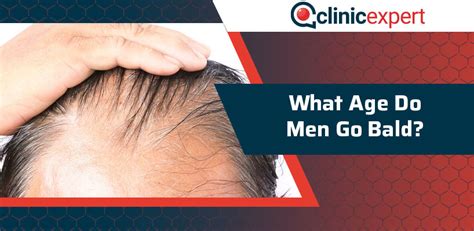 What age do most men go bald?