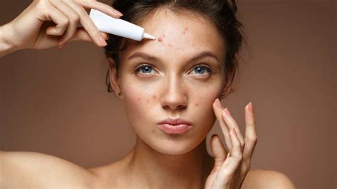 What age does acne go away?