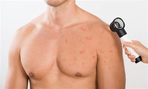 What age does chest acne go away?