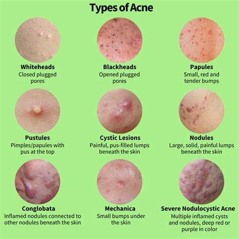 What age does chest acne go away?