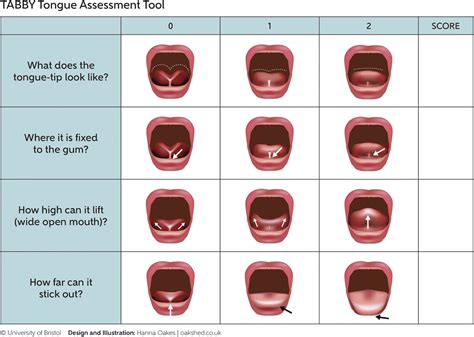 What age is best for tongue-tie release?
