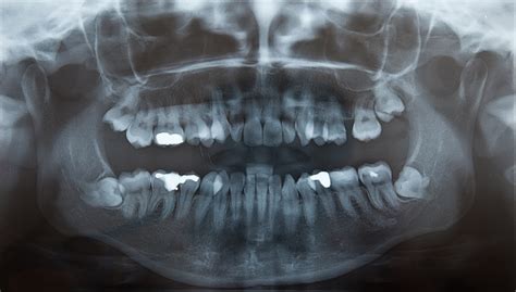 What antibiotics are used for third molar surgery?