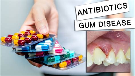 What are 3 day antibiotics for gum infection?