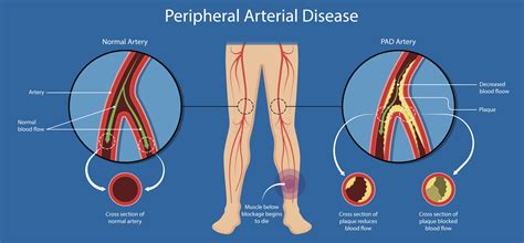 What are 3 signs of peripheral arterial disease?