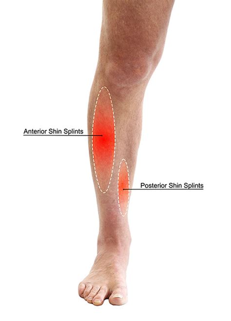 What are 3 signs symptoms of shin splints?