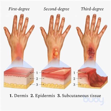 What are 3 symptoms of 2nd degree burns?