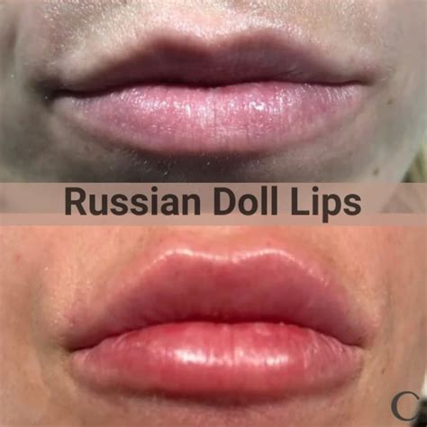 What are Russian doll lips?