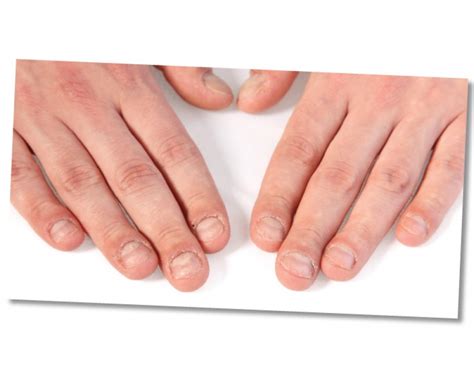 What are dehydrated nails?