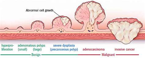 What are polyps associated with?